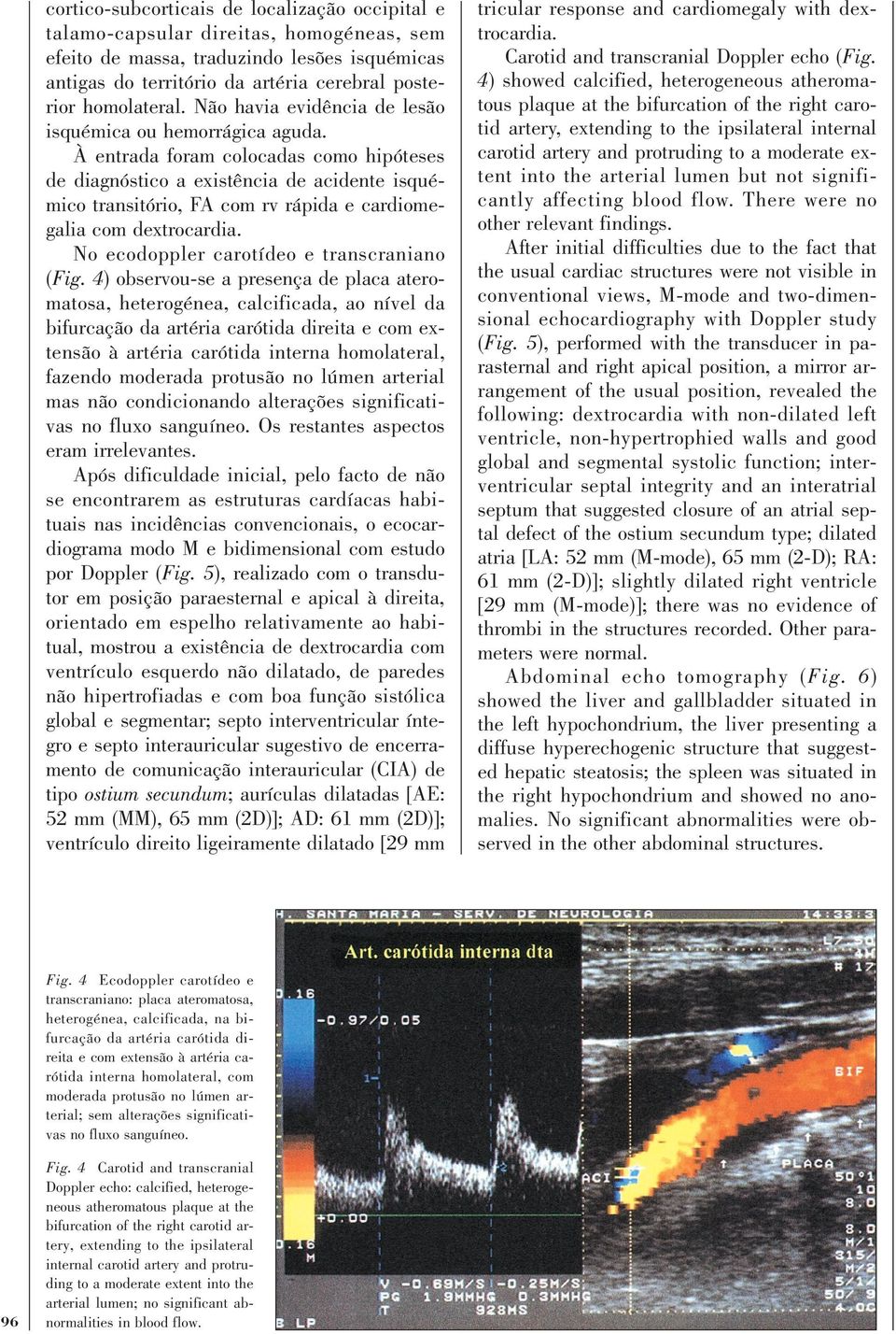 À entrada foram colocadas como hipóteses de diagnóstico a existência de acidente isquémico transitório, FA com rv rápida e cardiomegalia com dextrocardia. No ecodoppler carotídeo e transcraniano (Fig.