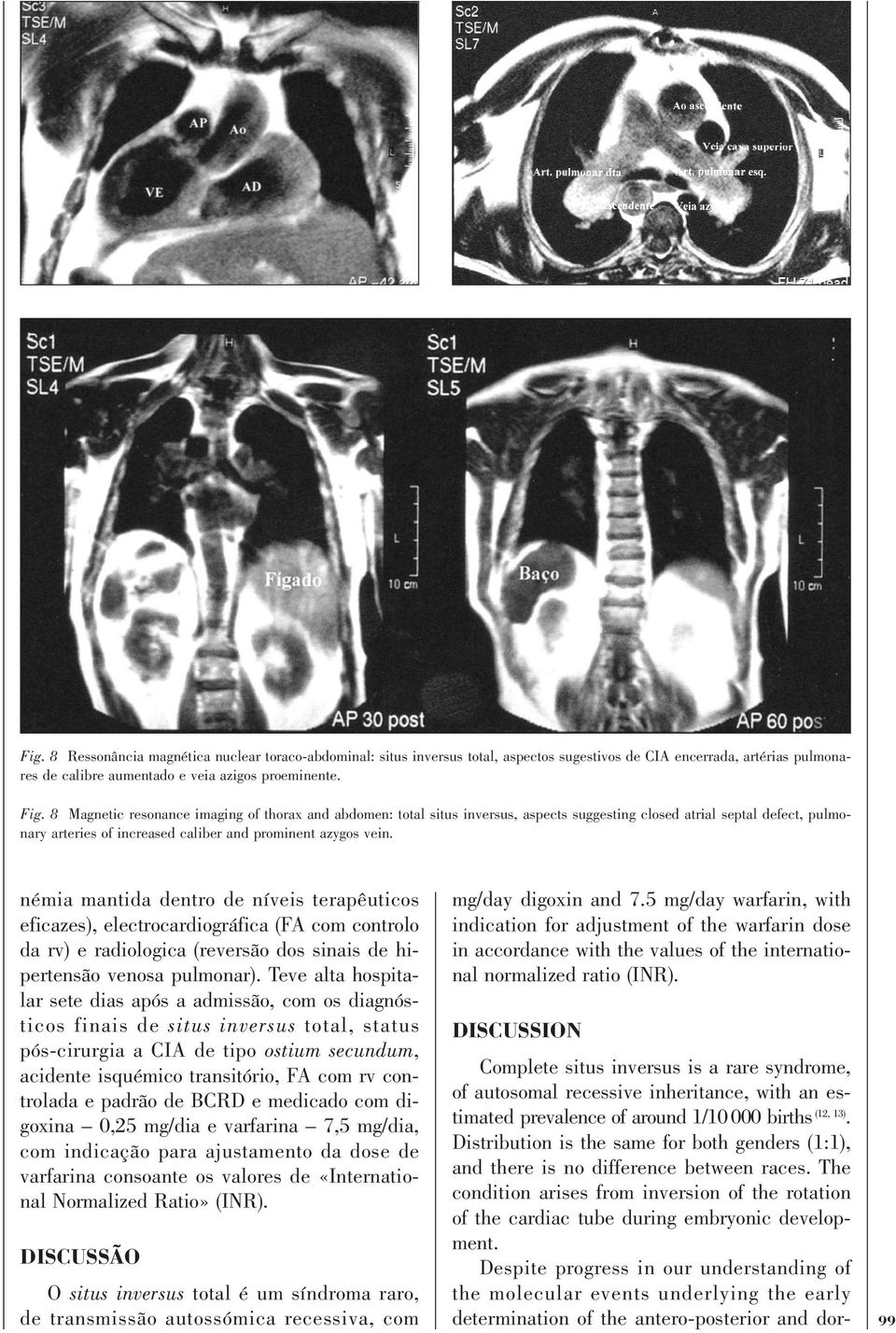 némia mantida dentro de níveis terapêuticos eficazes), electrocardiográfica (FA com controlo da rv) e radiologica (reversão dos sinais de hipertensão venosa pulmonar).