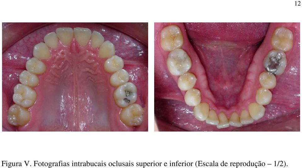 oclusais superior e