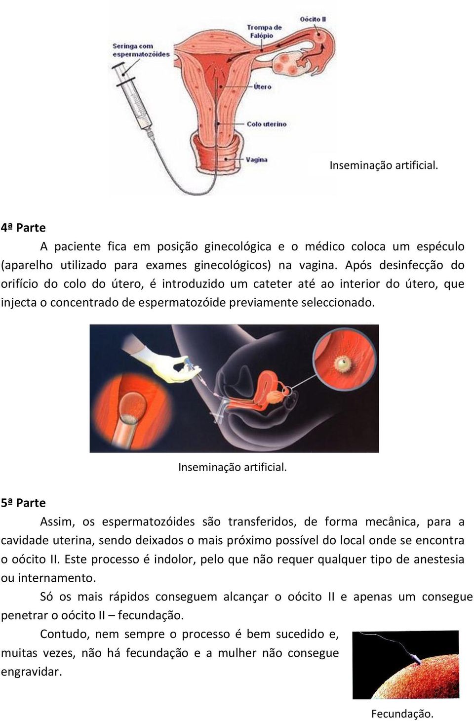 5ª Parte Assim, os espermatozóides são transferidos, de forma mecânica, para a cavidade uterina, sendo deixados o mais próximo possível do local onde se encontra o oócito II.