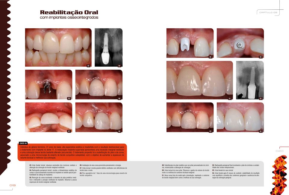 O tratamento proposto foi a substituição do pilar e da coroa, associado a uma microcirurgia de enxerto de tecido conjuntivo subepitelial, com o objetivo de aumentar a espessura do volume tecidual e