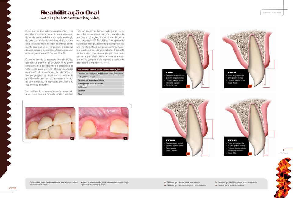 Figuras 03 e 04 O conhecimento da resposta de cada biótipo periodontal permite ao cirurgião e ao protesista ajustar a abordagem e a sequência de tratamento para permitir ótimos resultados estéticos