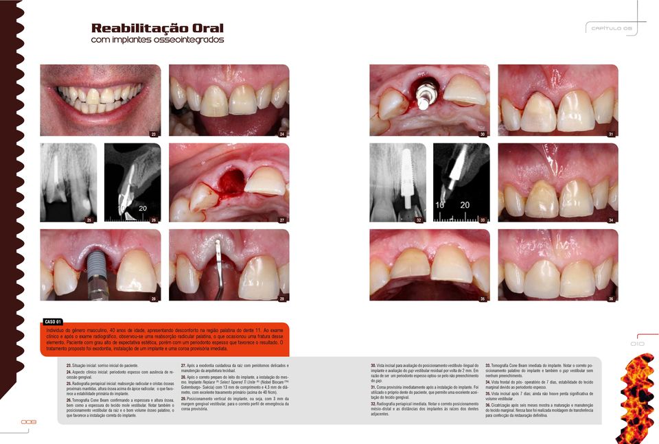 Paciente com grau alto de expectativa estética, porém com um periodonto espesso que favorece o resultado.