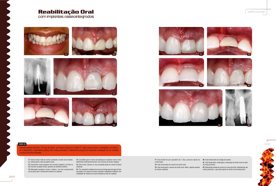 Sorriso inicial, linha do sorriso mostrando o tecido mole interdental, evidenciando a área da papila mesial. 72.