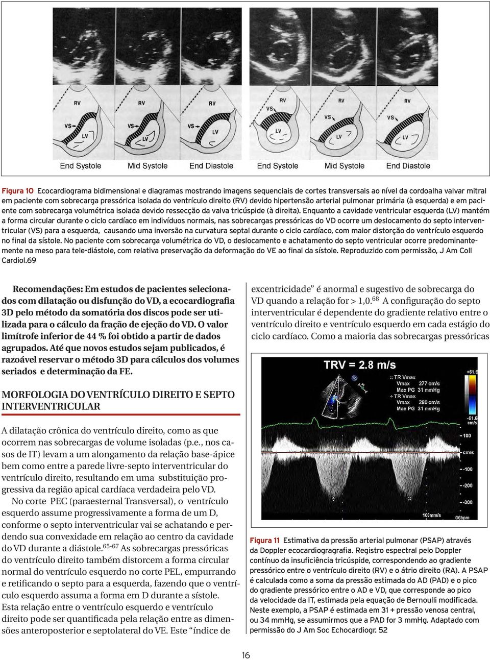 Enquanto a cavidade ventricular esquerda (LV) mantém a forma circular durante o ciclo cardíaco em indivíduos normais, nas sobrecargas pressóricas do VD ocorre um deslocamento do septo