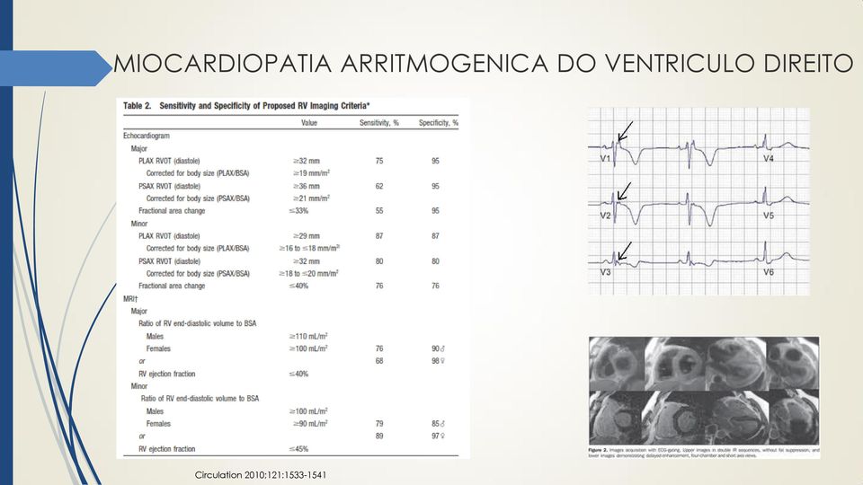 VENTRICULO DIREITO