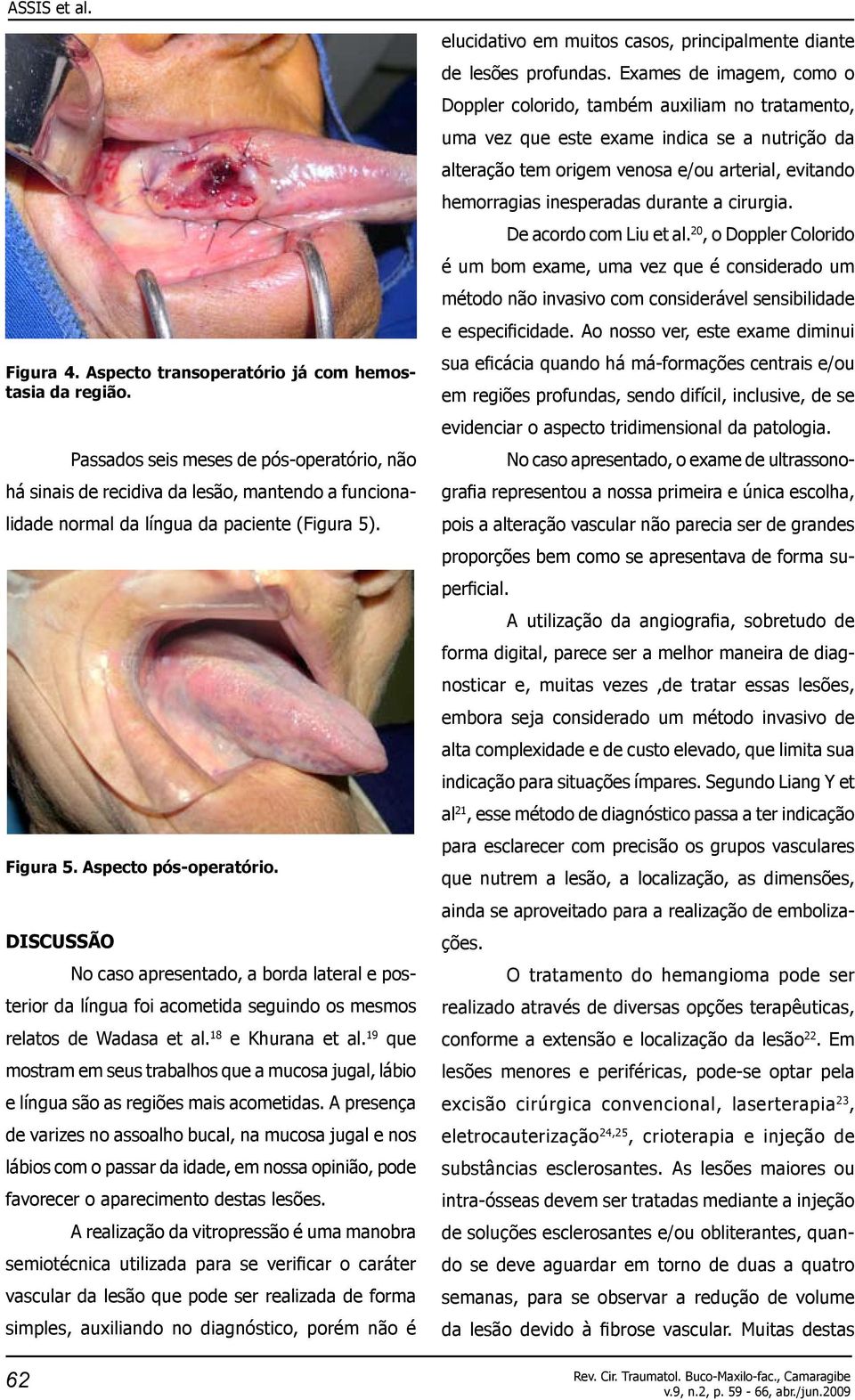 Discussão No caso apresentado, a borda lateral e posterior da língua foi acometida seguindo os mesmos relatos de Wadasa et al. 18 e Khurana et al.