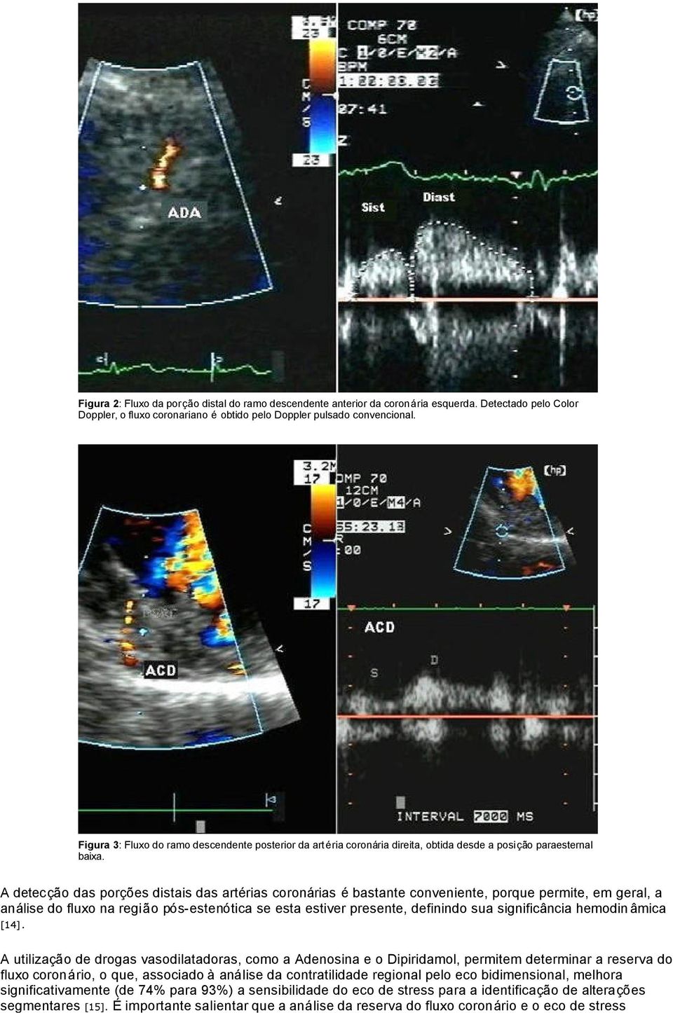 A detecção das porções distais das artérias coronárias é bastante conveniente, porque permite, em geral, a análise do fluxo na região pós-estenótica se esta estiver presente, definindo sua