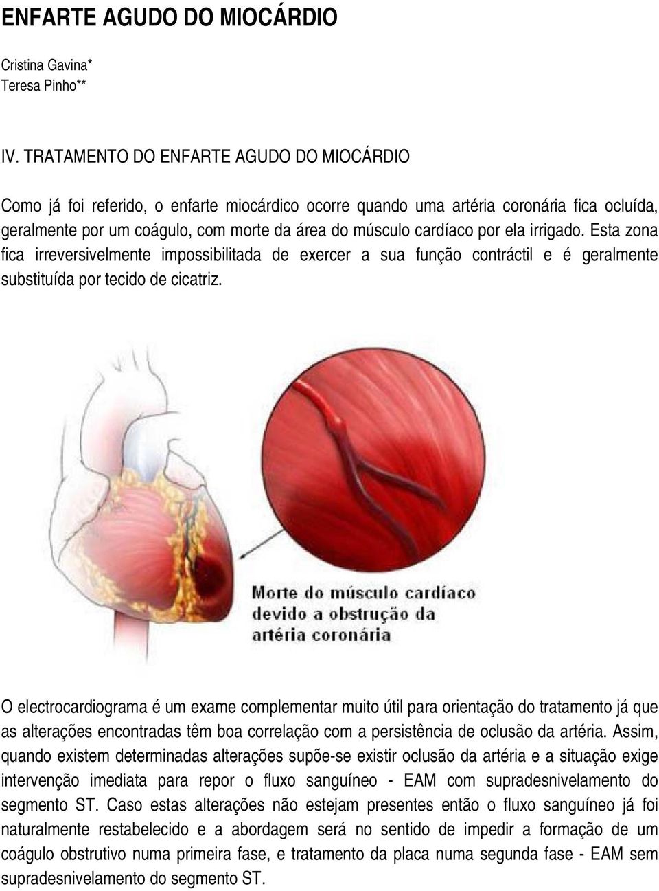 por ela irrigado. Esta zona fica irreversivelmente impossibilitada de exercer a sua função contráctil e é geralmente substituída por tecido de cicatriz.