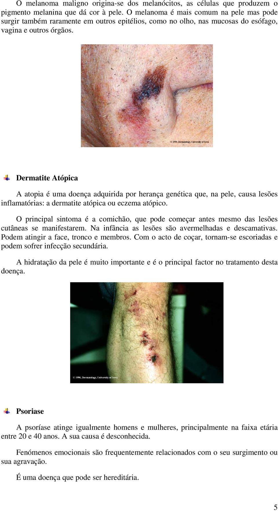 Dermatite Atópica A atopia é uma doença adquirida por herança genética que, na pele, causa lesões inflamatórias: a dermatite atópica ou eczema atópico.