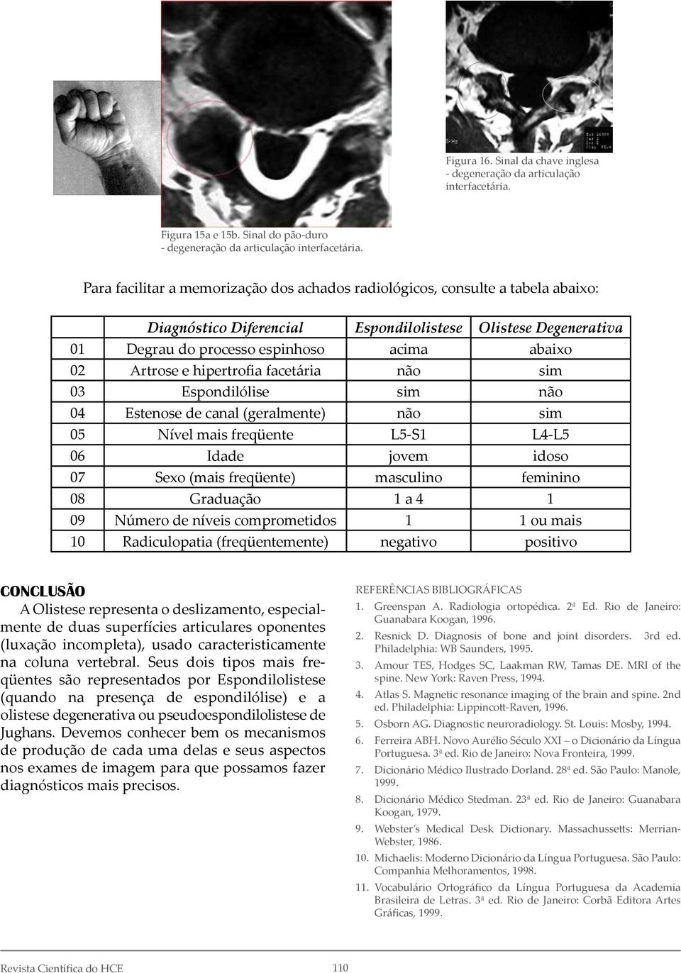 e hipertrofia facetária não sim 03 Espondilólise sim não 04 Estenose de canal (geralmente) não sim 05 Nível mais freqüente L5-S1 L4-L5 06 Idade jovem idoso 07 Sexo (mais freqüente) masculino feminino