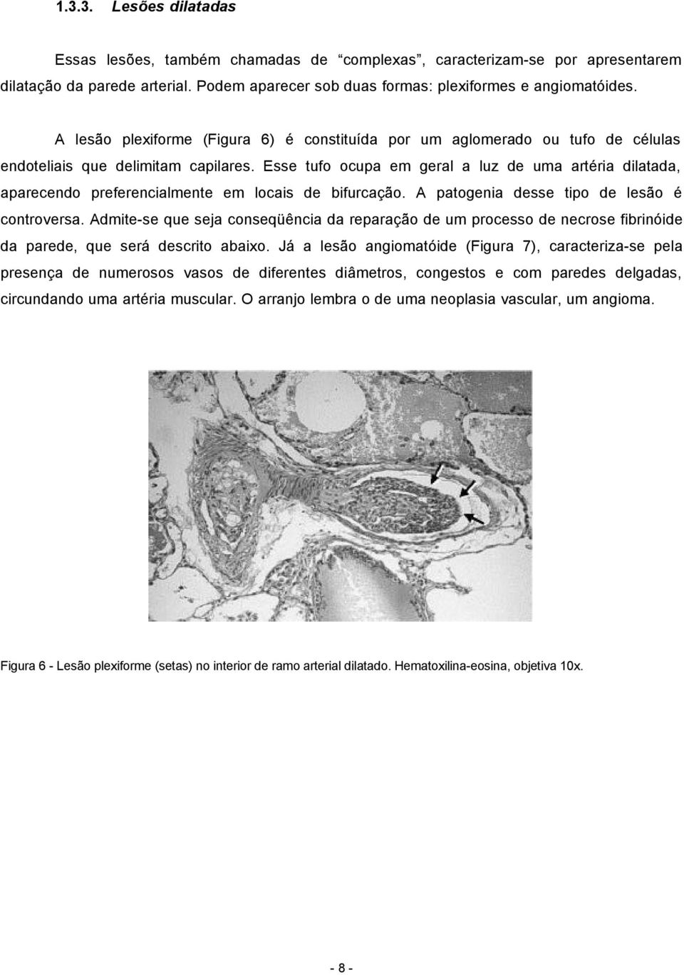 Esse tufo ocupa em geral a luz de uma artéria dilatada, aparecendo preferencialmente em locais de bifurcação. A patogenia desse tipo de lesão é controversa.