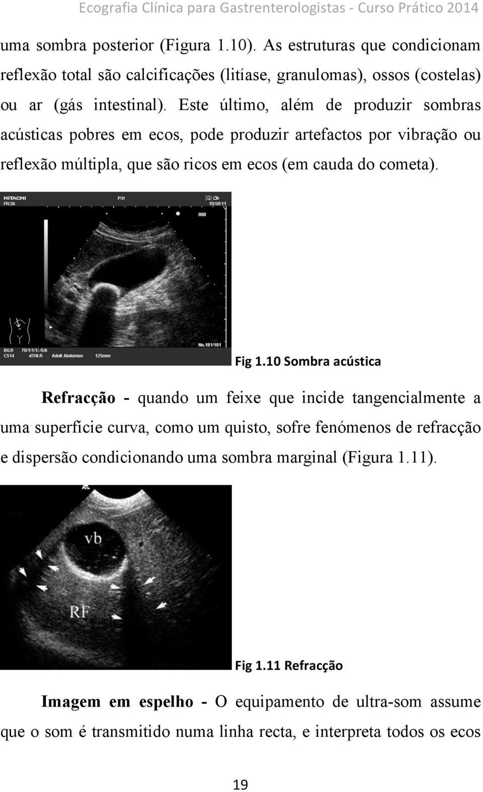 Este último, além de produzir sombras acústicas pobres em ecos, pode produzir artefactos por vibração ou reflexão múltipla, que são ricos em ecos (em cauda do cometa). Fig 1.