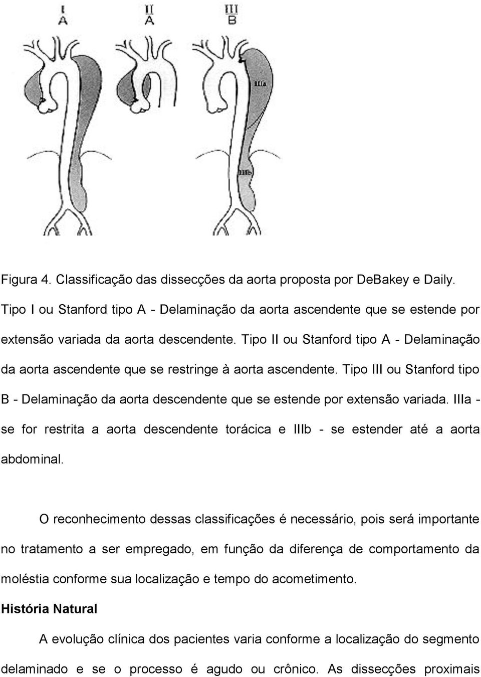 IIIa - se for restrita a aorta descendente torácica e IIIb - se estender até a aorta abdominal.