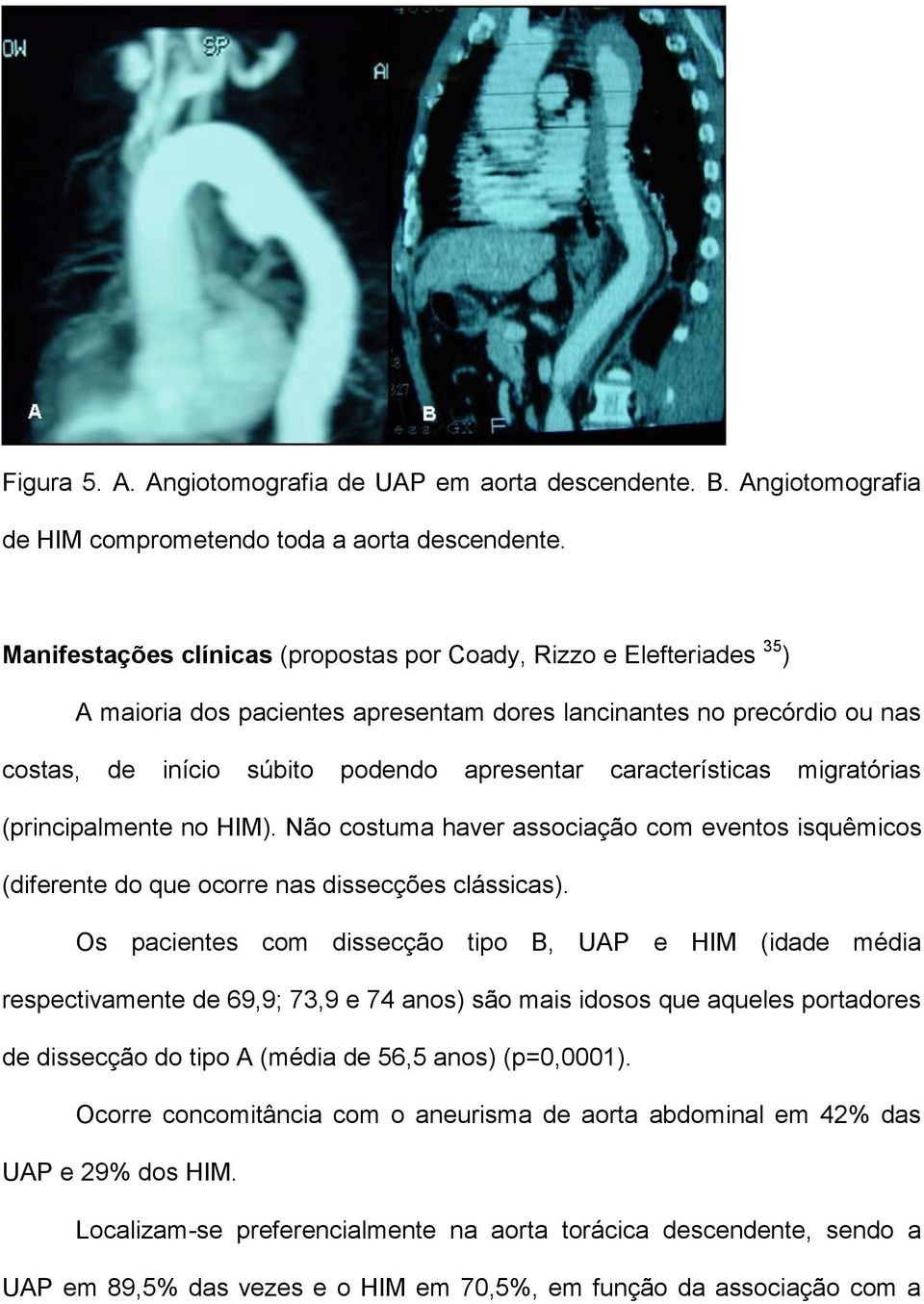 características migratórias (principalmente no HIM). Não costuma haver associação com eventos isquêmicos (diferente do que ocorre nas dissecções clássicas).