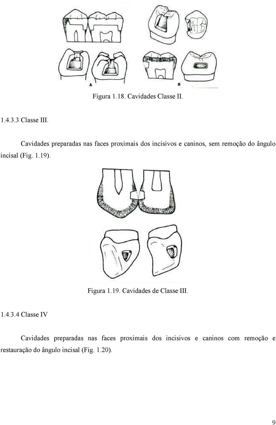 ângulo incisal (Fig. 1.19). Figura 1.19. Cavidades de Classe III. 1.4.3.