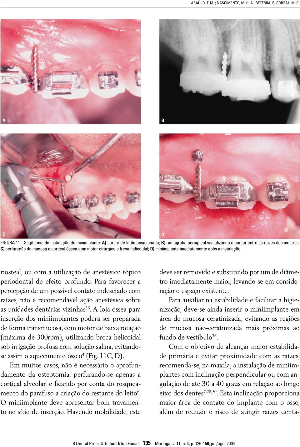 óssea com motor cirúrgico e fresa helicoidal; D) miniimplante imediatamente após a instalação. D riosteal, ou com a utilização de anestésico tópico periodontal de efeito profundo.