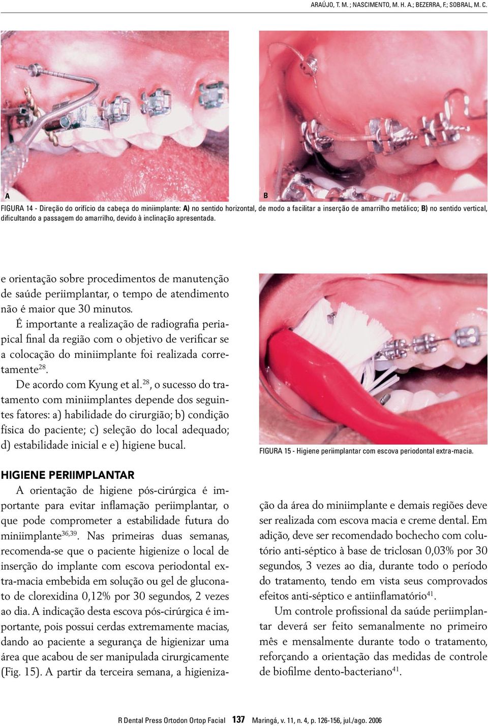 devido à inclinação apresentada. e orientação sobre procedimentos de manutenção de saúde periimplantar, o tempo de atendimento não é maior que 30 minutos.