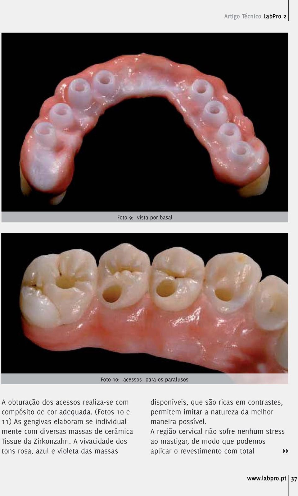 (Fotos 10 e 11) As gengivas elaboram-se individualmente com diversas massas de cerâmica Tissue da Zirkonzahn.