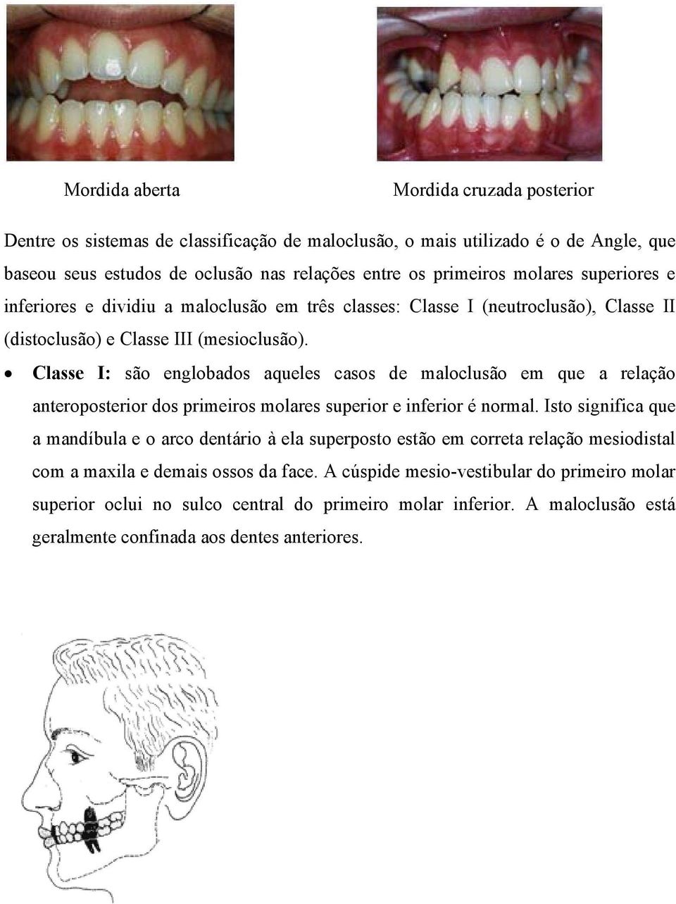 Classe I: são englobados aqueles casos de maloclusão em que a relação anteroposterior dos primeiros molares superior e inferior é normal.