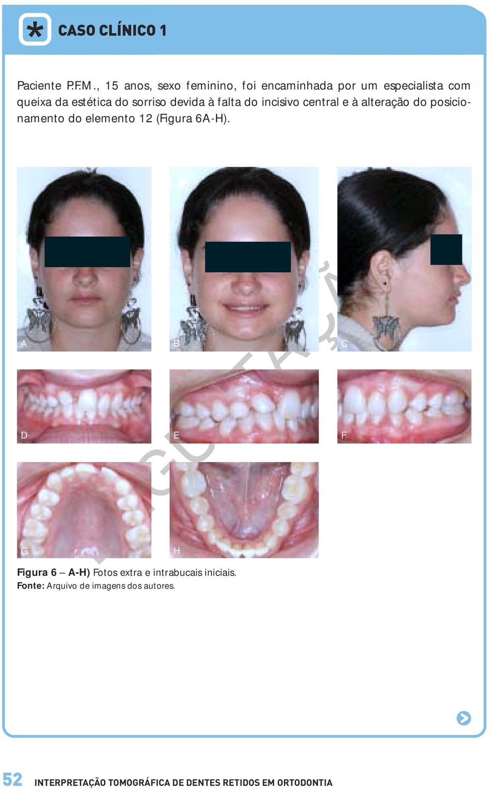 estética do sorriso devida à falta do incisivo central e à alteração do