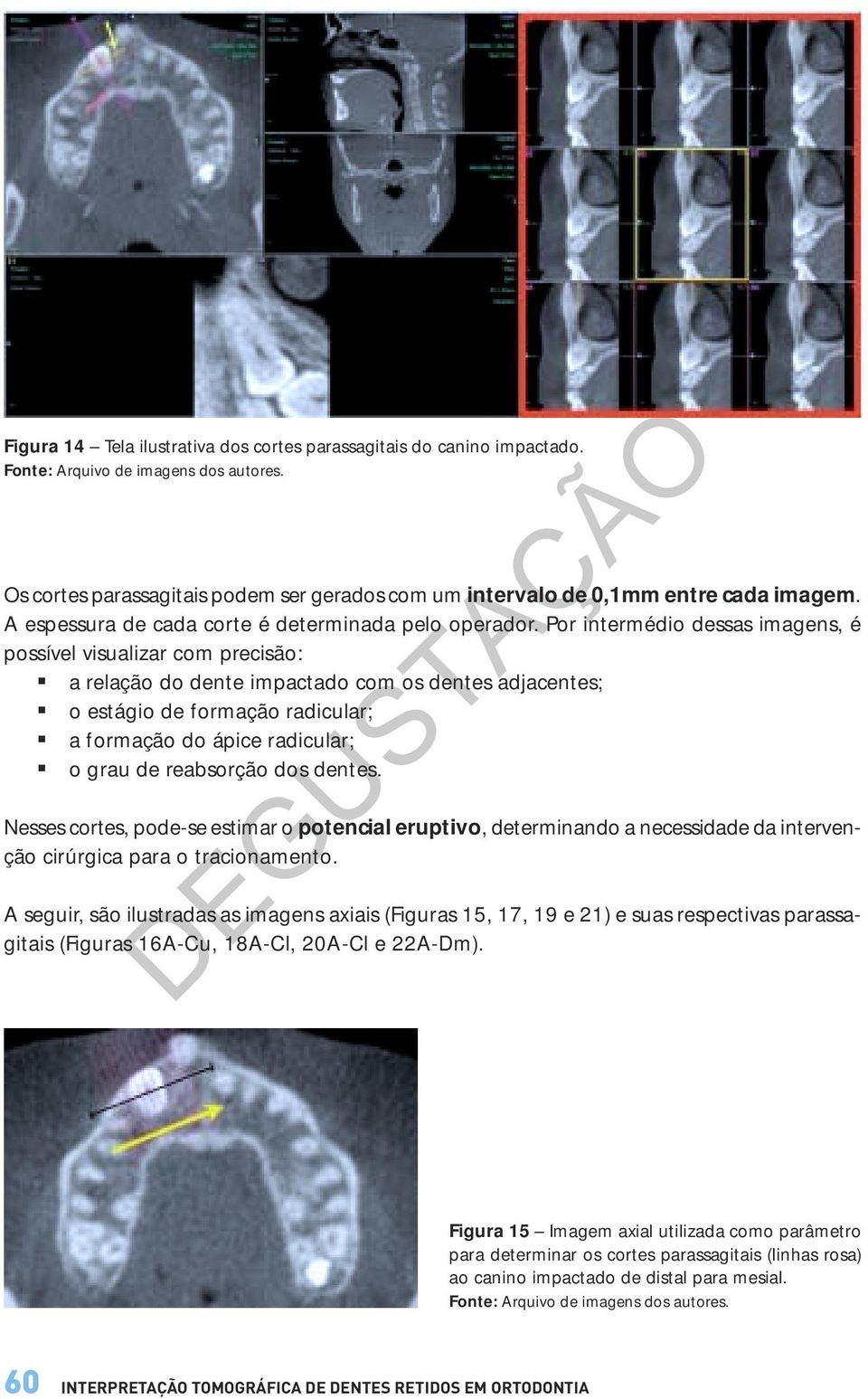 Por intermédio dessas imagens, é possível visualizar com precisão: a relação do dente impactado com os dentes adjacentes; o estágio de formação radicular; a formação do ápice radicular; o grau de