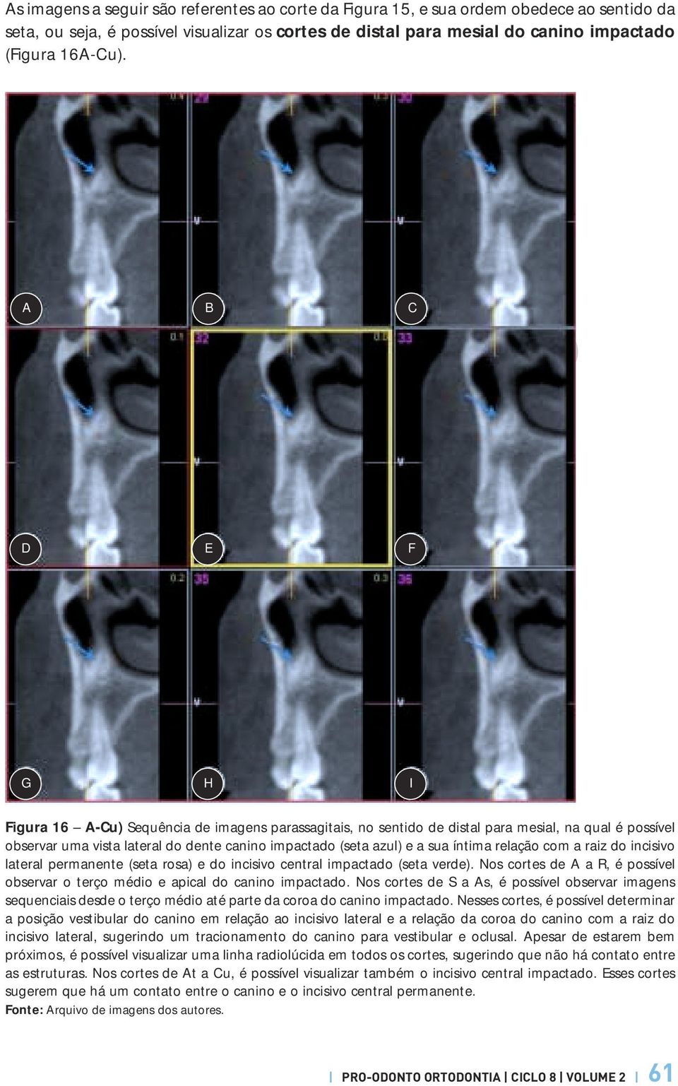 íntima relação com a raiz do incisivo lateral permanente (seta rosa) e do incisivo central impactado (seta verde). Nos cortes de A a R, é possível observar o terço médio e apical do canino impactado.