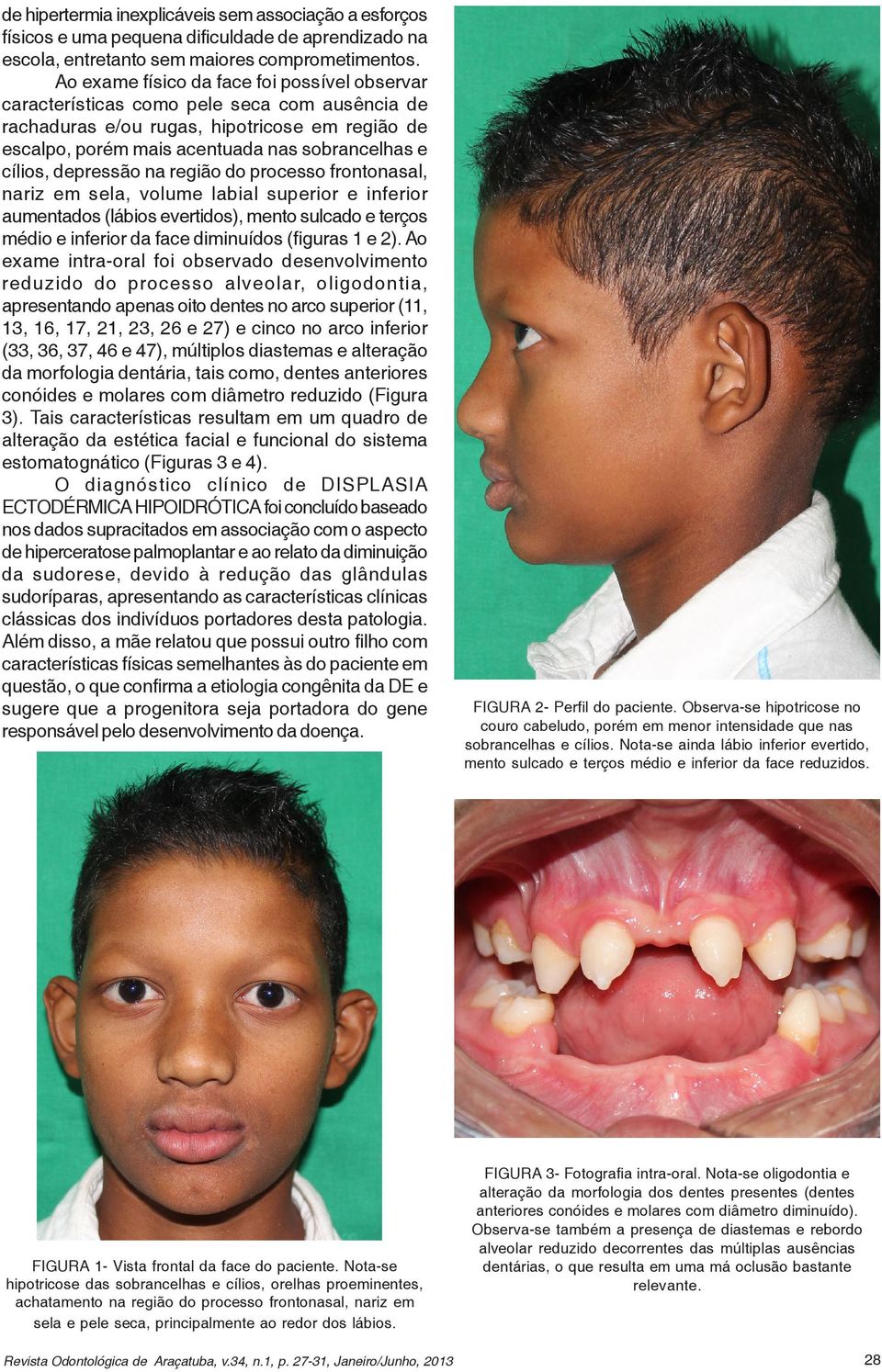 depressão na região do processo frontonasal, nariz em sela, volume labial superior e inferior aumentados (lábios evertidos), mento sulcado e terços médio e inferior da face diminuídos (figuras 1 e 2).