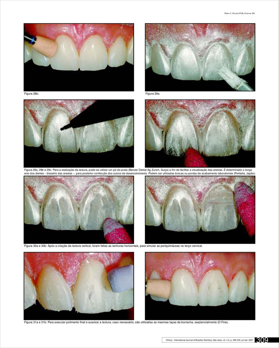 É determinado o longo eixo dos dentes bissetriz das arestas, para posterior confecção dos sulcos de desenvolvimento.