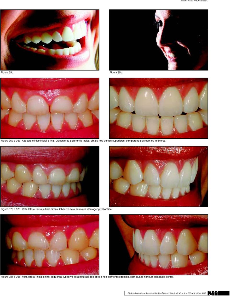Figura 37a e 37b: Vista lateral inicial e final direita. Observe-se a harmonia dentogengival obtida.