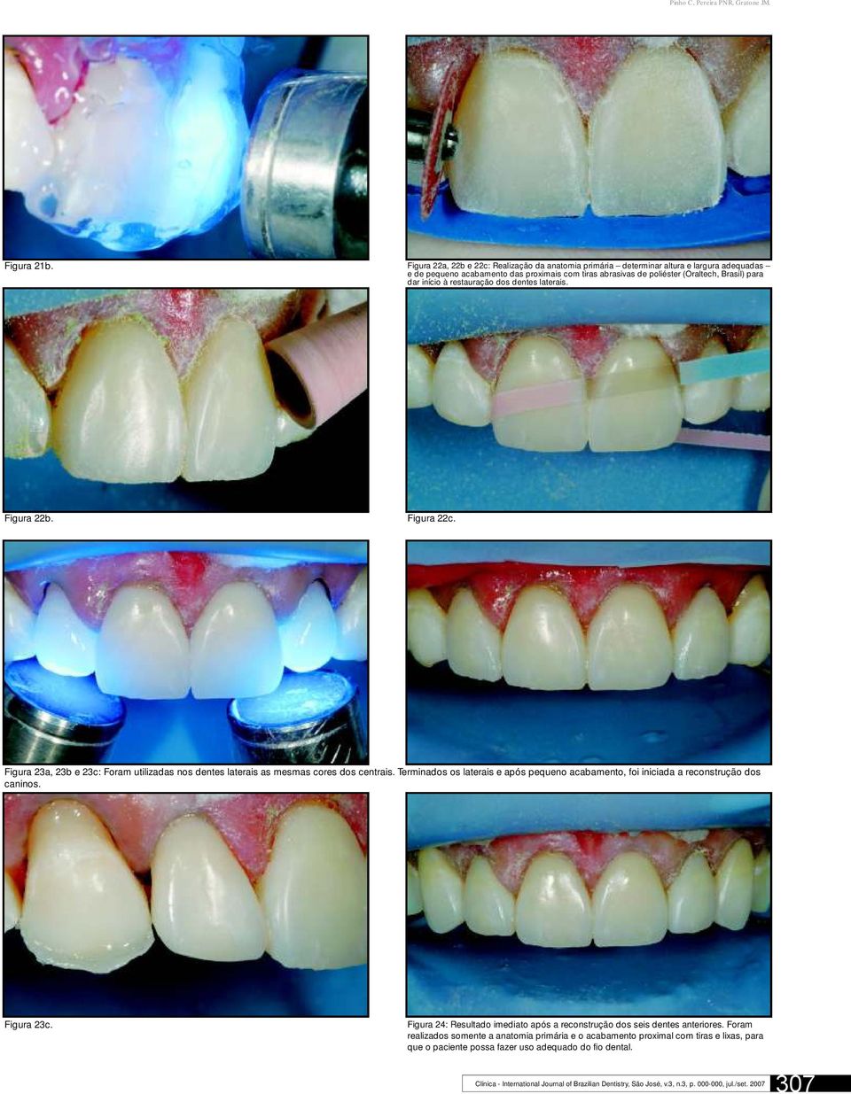 à restauração dos dentes laterais. Figura 22b. Figura 22c. Figura 23a, 23b e 23c: Foram utilizadas nos dentes laterais as mesmas cores dos centrais.