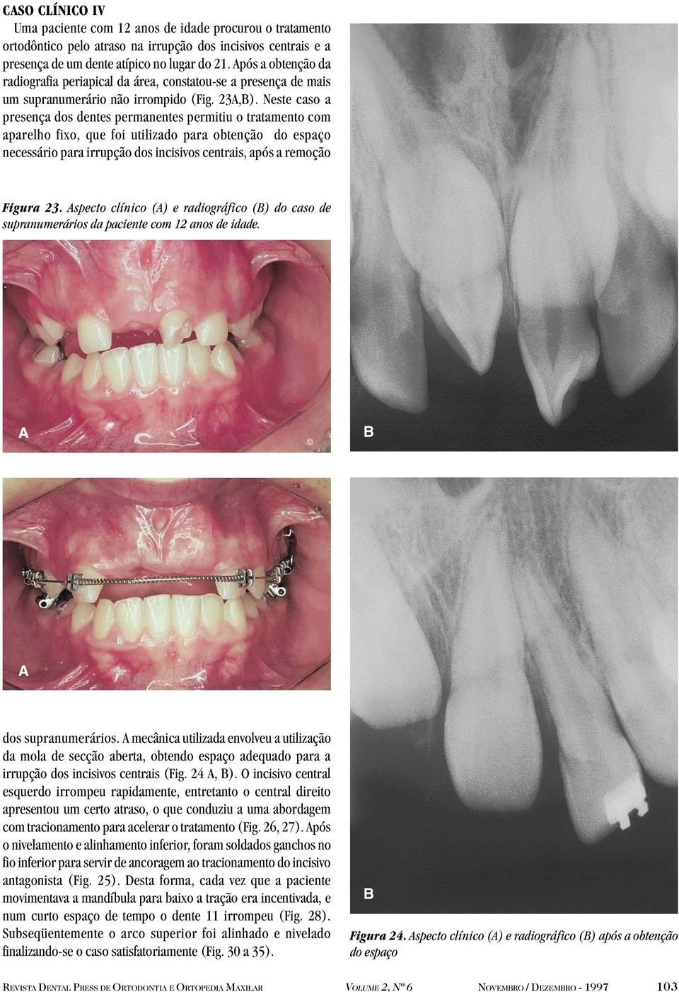 Neste caso a presença dos dentes permanentes permitiu o tratamento com aparelho fixo, que foi utilizado para obtenção do espaço necessário para irrupção dos incisivos centrais, após a remoção Figura