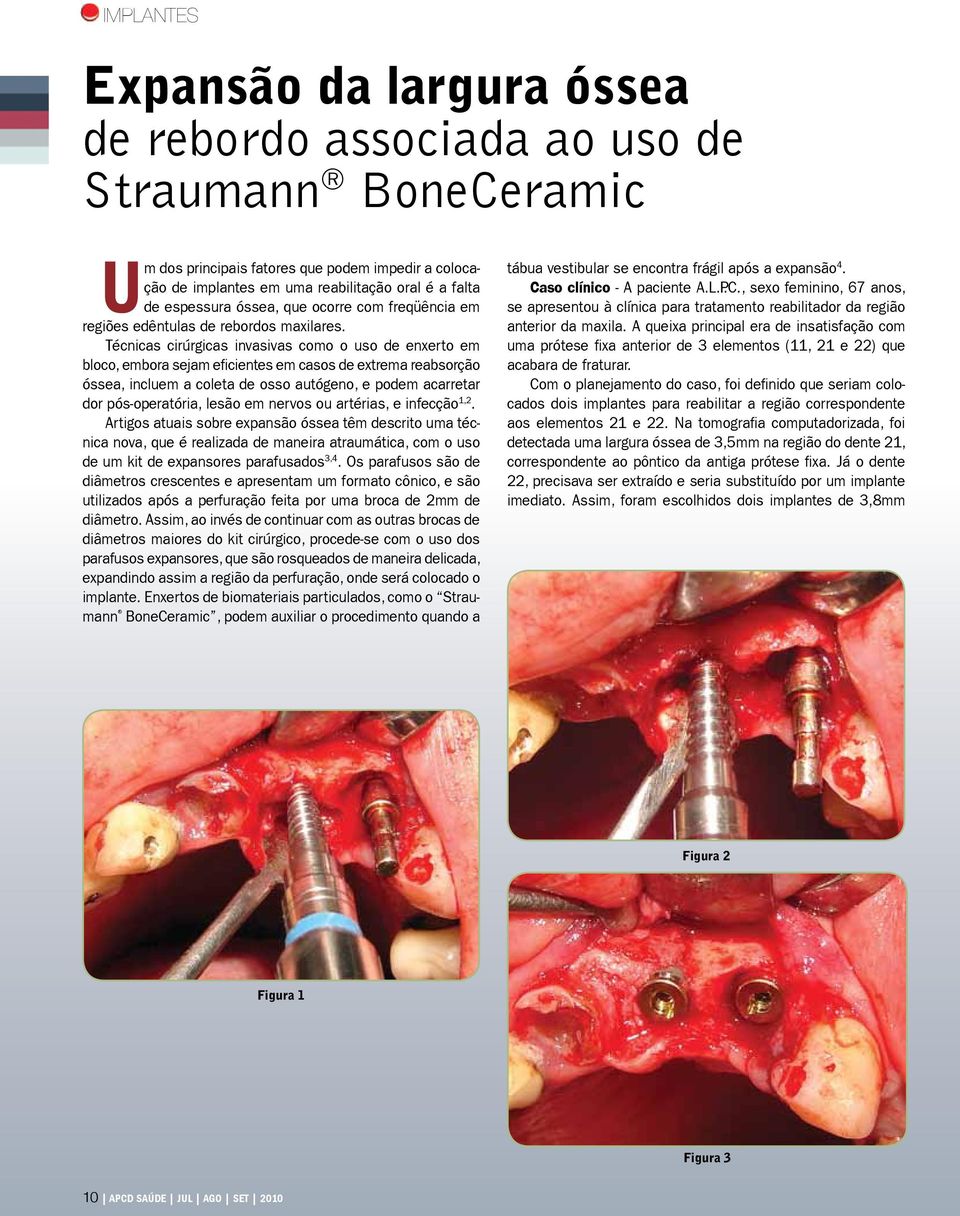 Técnicas cirúrgicas invasivas como o uso de enxerto em bloco, embora sejam eficientes em casos de extrema reabsorção óssea, incluem a coleta de osso autógeno, e podem acarretar dor pós-operatória,