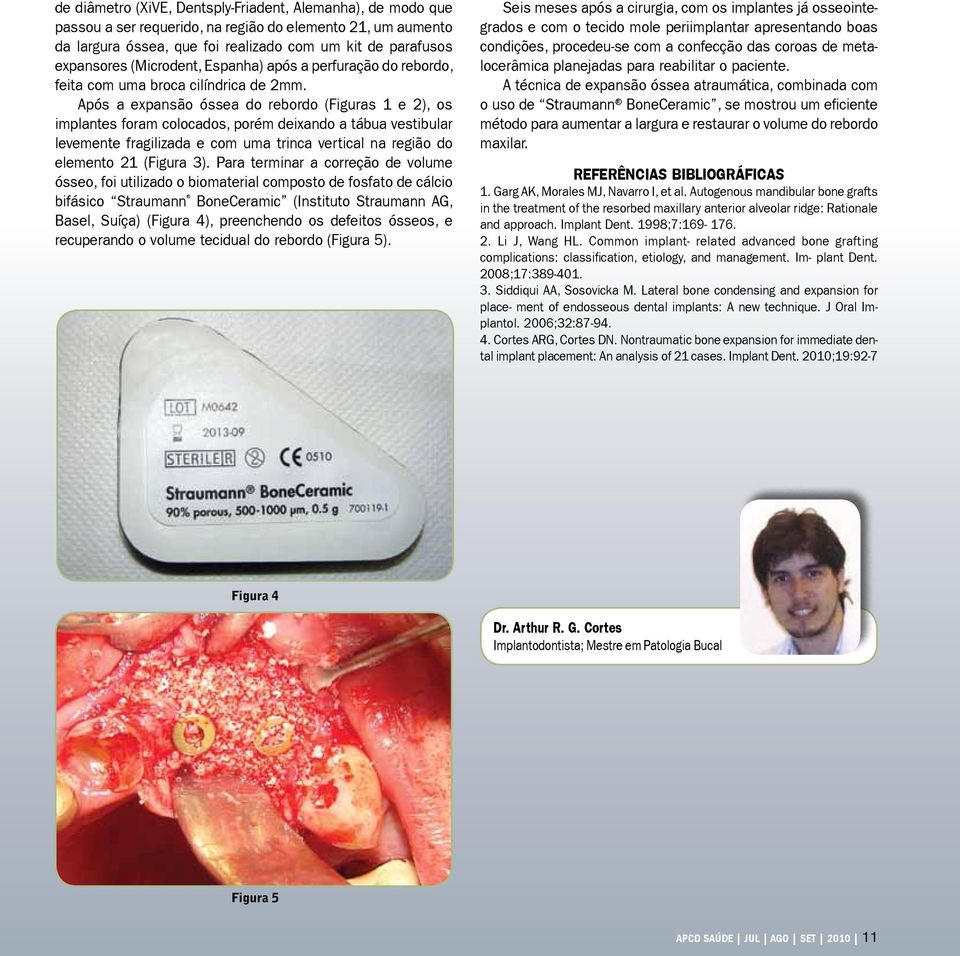 Após a expansão óssea do rebordo (Figuras 1 e 2), os implantes foram colocados, porém deixando a tábua vestibular levemente fragilizada e com uma trinca vertical na região do elemento 21 (Figura 3).