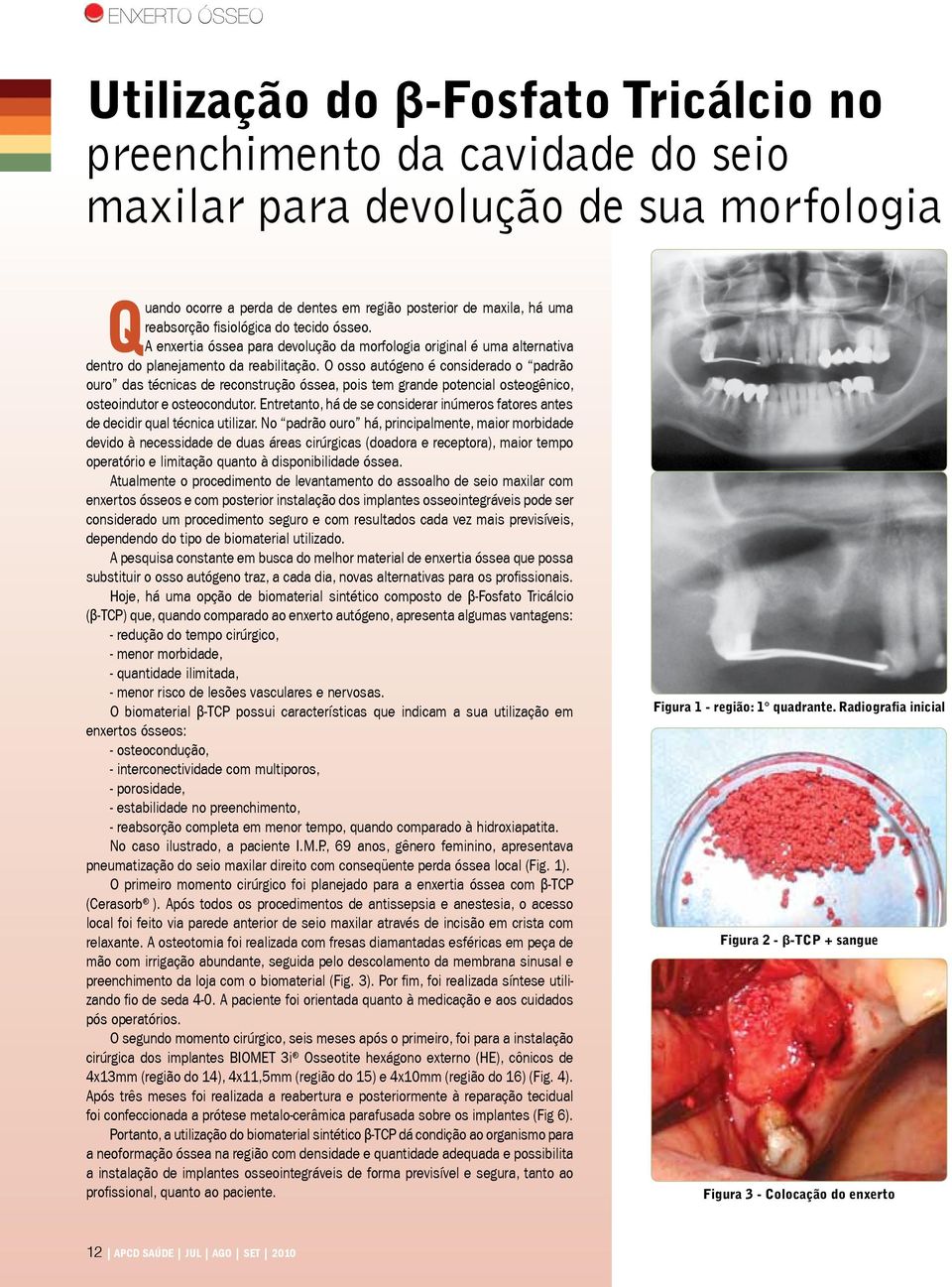 O osso autógeno é considerado o padrão ouro das técnicas de reconstrução óssea, pois tem grande potencial osteogênico, osteoindutor e osteocondutor.