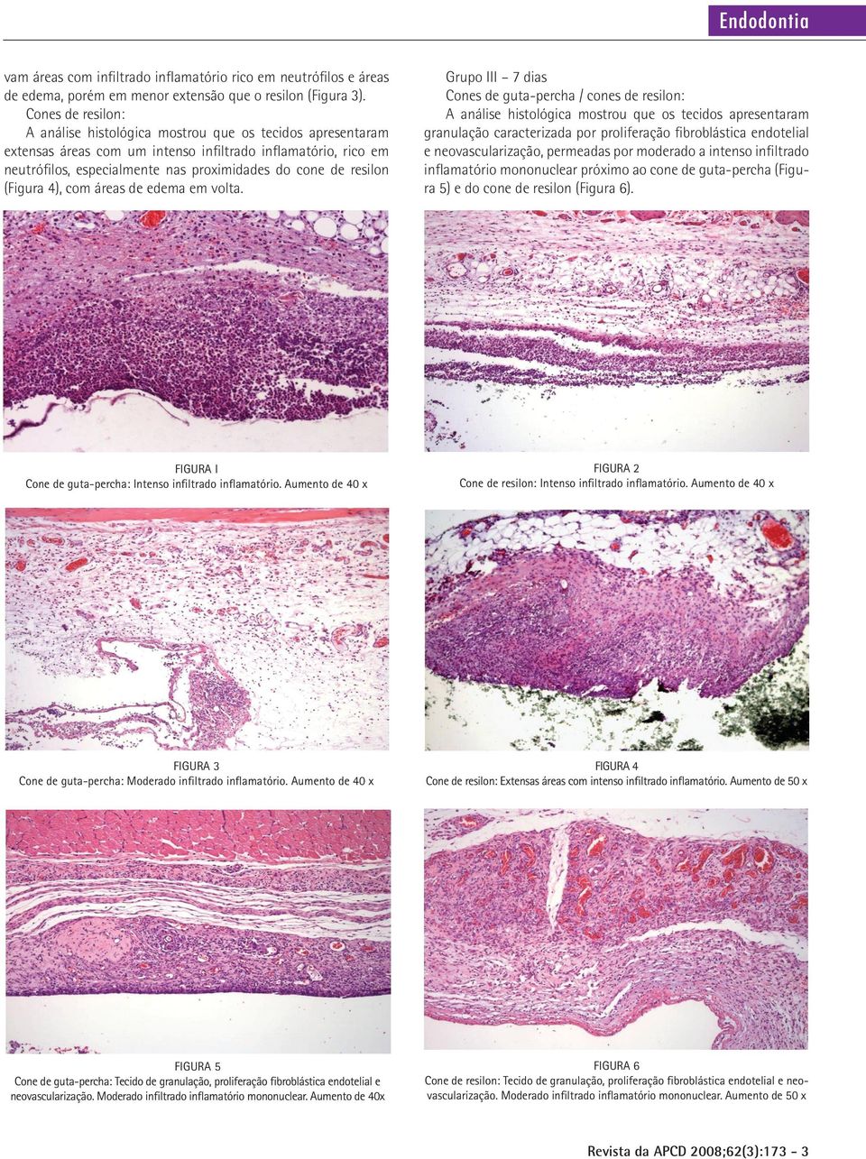 Grupo III 7 dias Cones de guta-percha / cones de resilon: granulação caracterizada por proliferação fibroblástica endotelial e neovascularização, permeadas por moderado a intenso infiltrado