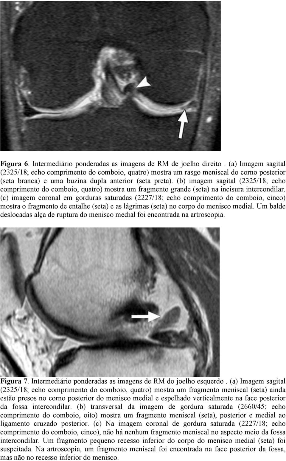 (b) imagem sagital (2325/18; echo comprimento do comboio, quatro) mostra um fragmento grande (seta) na incisura intercondilar.