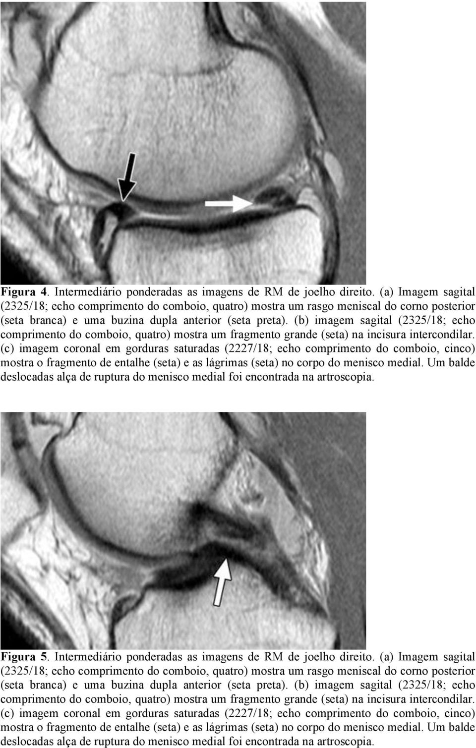 (b) imagem sagital (2325/18; echo comprimento do comboio, quatro) mostra um fragmento grande (seta) na incisura intercondilar.