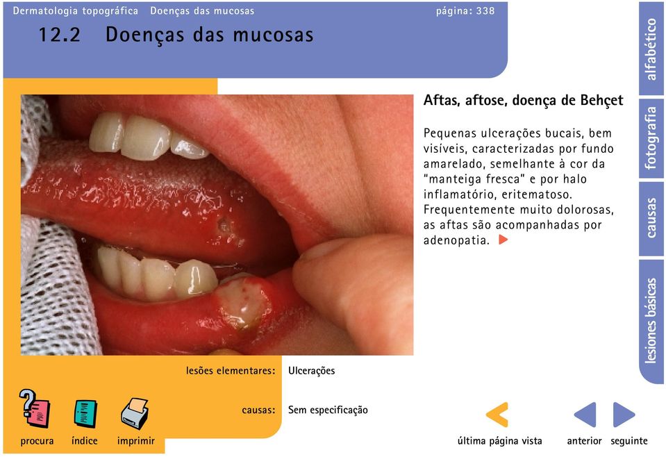 visíveis, caracterizadas por fundo amarelado, semelhante à cor da manteiga fresca e por