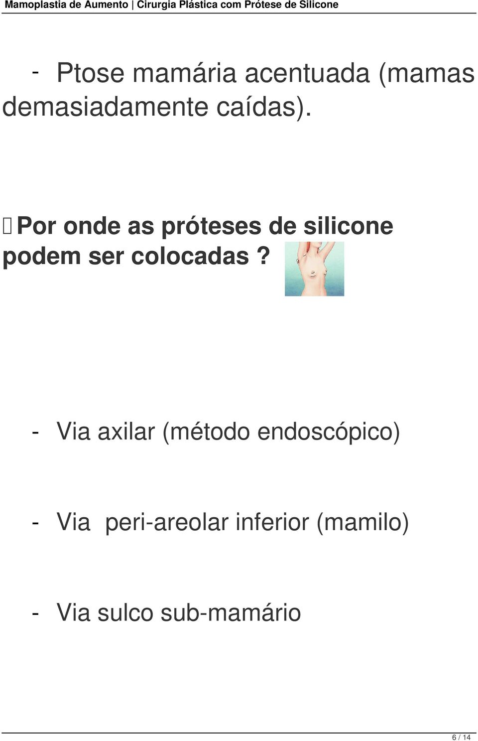 Por onde as próteses de silicone podem ser colocadas?