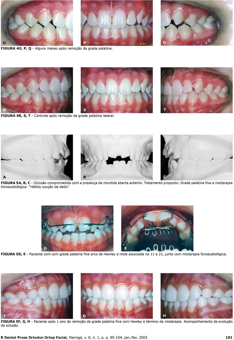 Hábito sucção de dedo. D FIGURA 5D, E - Paciente com com grade palatina fixa arco de Hawley e mola associada no 11 e 21, junto com mioterapia fonoaudiológica.