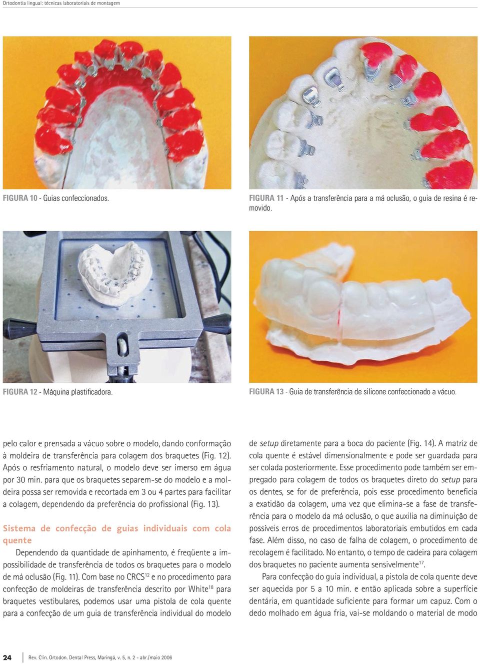 pelo calor e prensada a vácuo sobre o modelo, dando conformação à moldeira de transferência para colagem dos braquetes (Fig. 12).