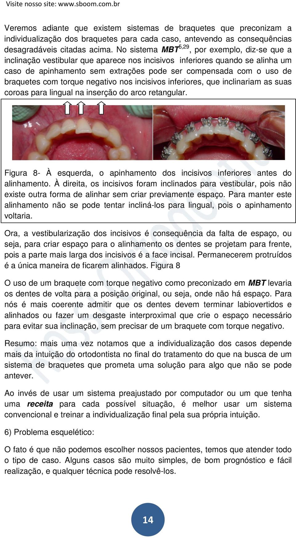 braquetes com torque negativo nos incisivos inferiores, que inclinariam as suas coroas para lingual na inserção do arco retangular.