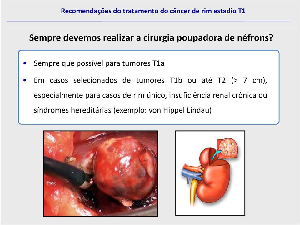 tumores T1b ou até T2 (> 7 cm), especialmente para casos de rim