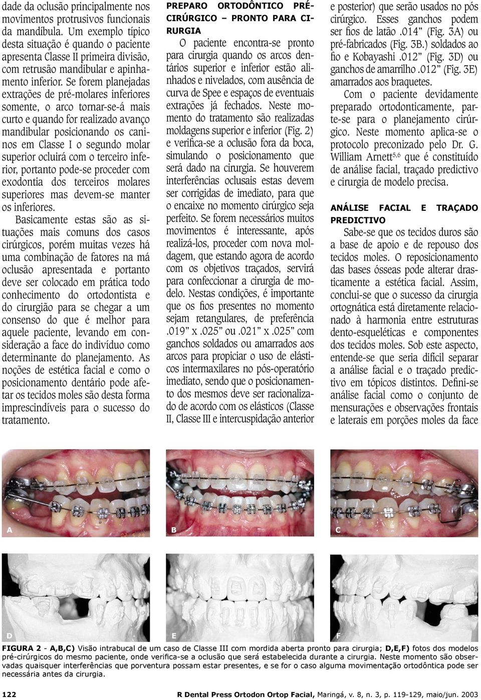 Se forem planejadas extrações de pré-molares inferiores somente, o arco tornar-se-á mais curto e quando for realizado avanço mandibular posicionando os caninos em Classe I o segundo molar superior