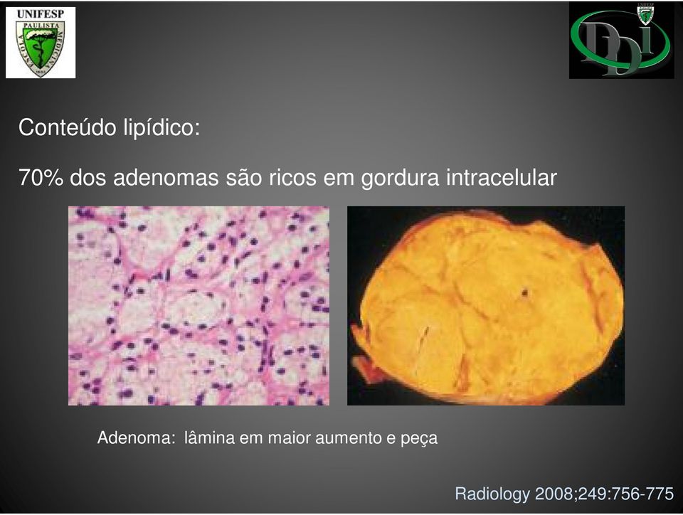 intracelular Adenoma: lâmina em