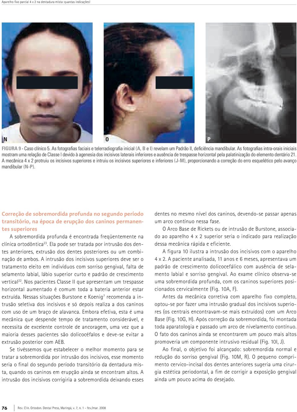 As fotografias intra-orais iniciais mostram uma relação de Classe I devido à agenesia dos incisivos laterais inferiores e ausência de trespasse horizontal pela palatinização do elemento dentário 21.