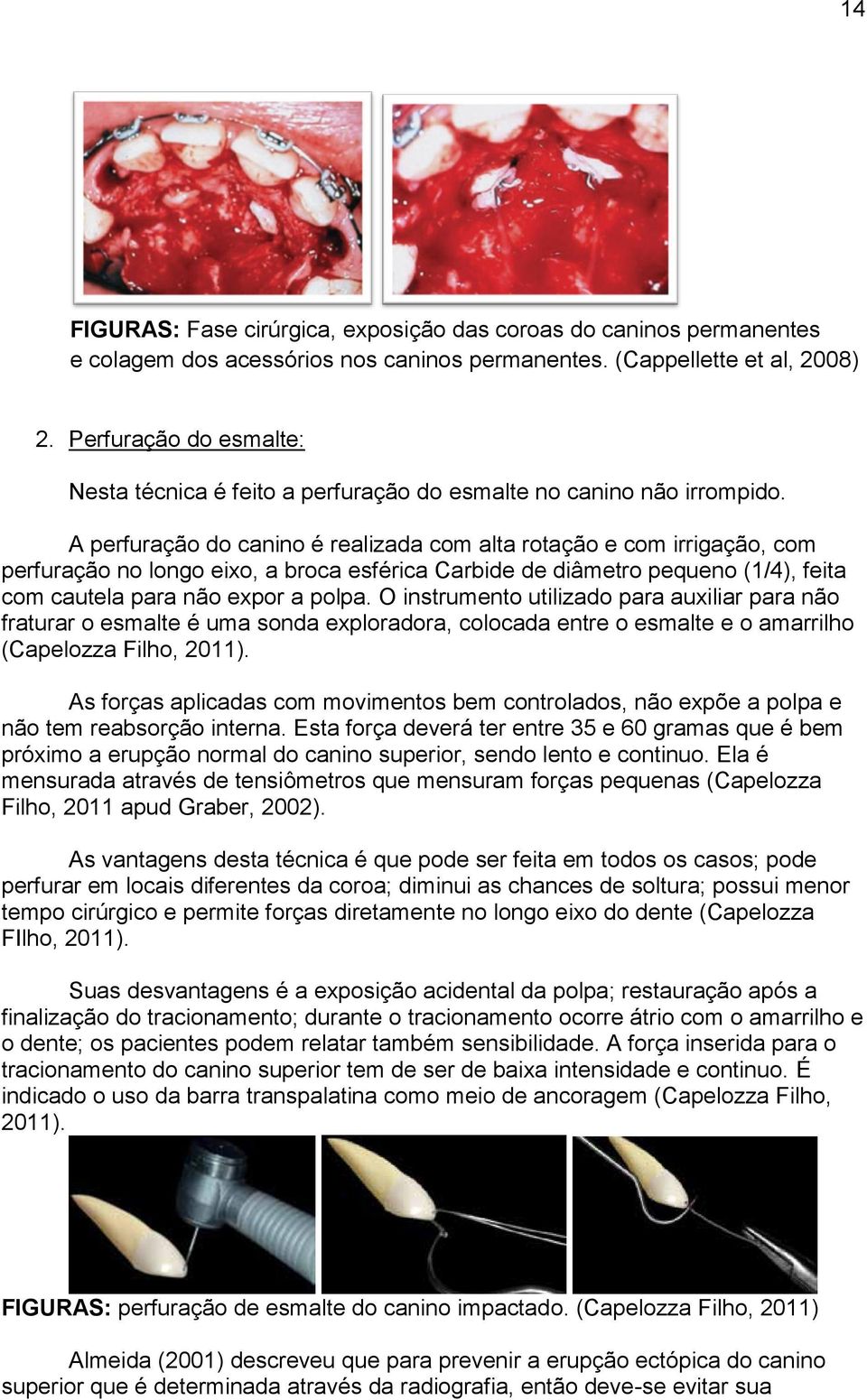 A perfuração do canino é realizada com alta rotação e com irrigação, com perfuração no longo eixo, a broca esférica Carbide de diâmetro pequeno (1/4), feita com cautela para não expor a polpa.