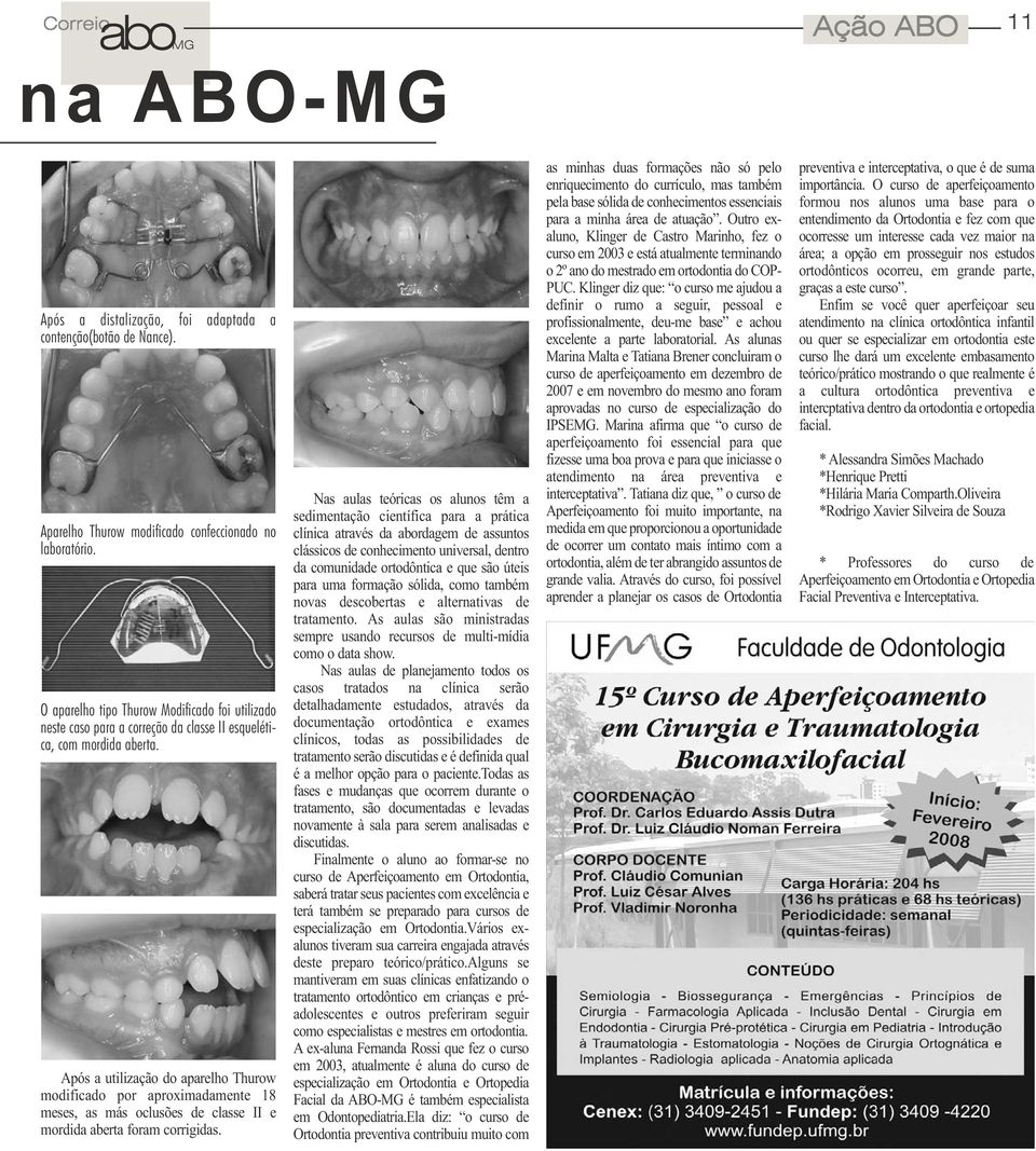 Após a utilização do aparelho Thurow modificado por aproximadamente 18 meses, as más oclusões de classe II e mordida aberta foram corrigidas.