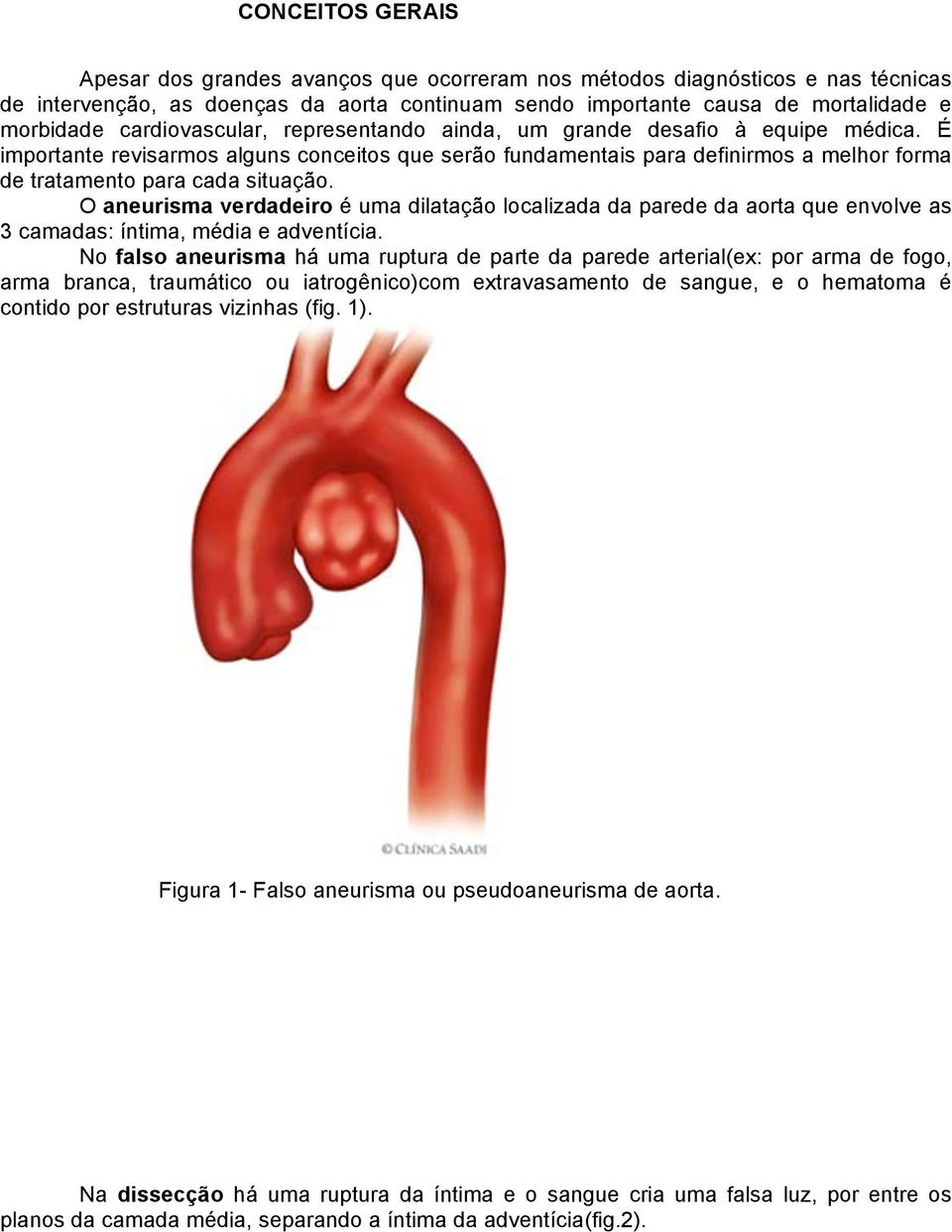 O aneurisma verdadeiro é uma dilatação localizada da parede da aorta que envolve as 3 camadas: íntima, média e adventícia.